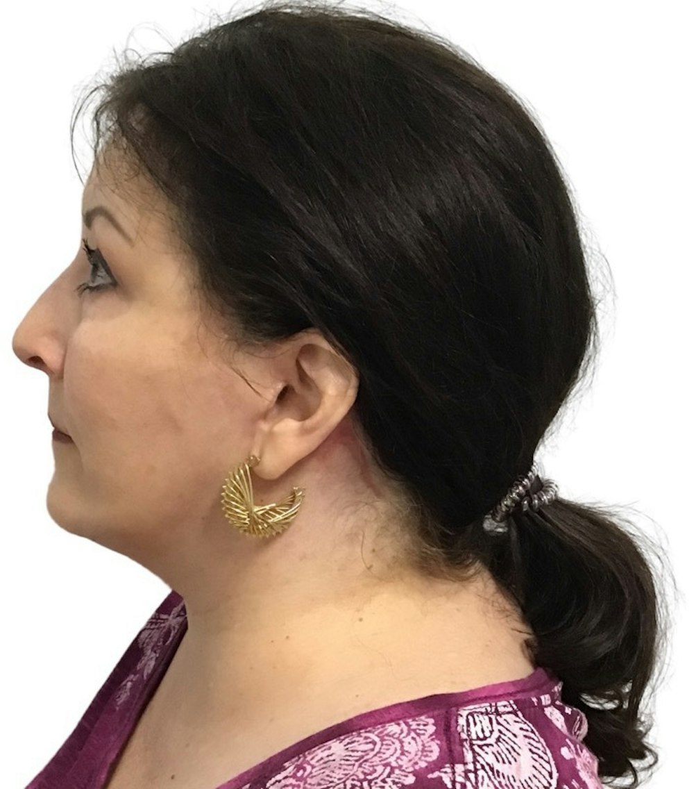 Facelift Before & After Gallery - Patient 13948538 - Image 4