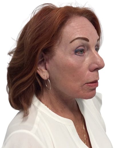 Deep Plane Facelift Before & After Gallery - Patient 13948537 - Image 6
