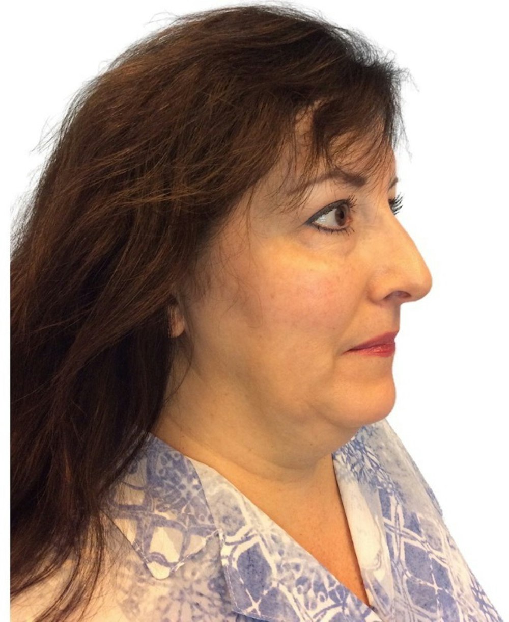 Facelift Before & After Gallery - Patient 13948538 - Image 5