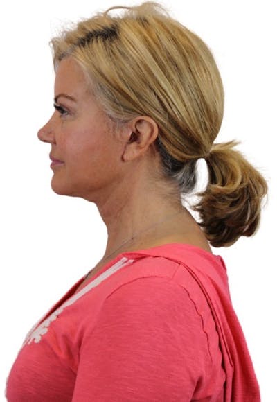 Deep Plane Facelift Before & After Gallery - Patient 13948539 - Image 4