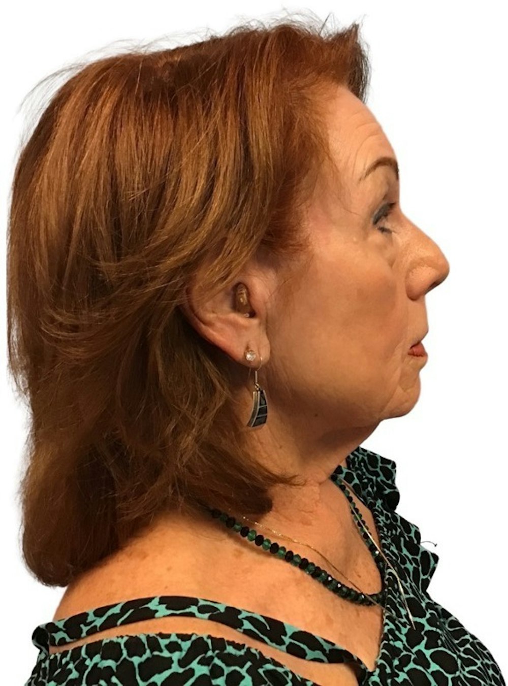 Deep Plane Facelift Before & After Gallery - Patient 13948537 - Image 7