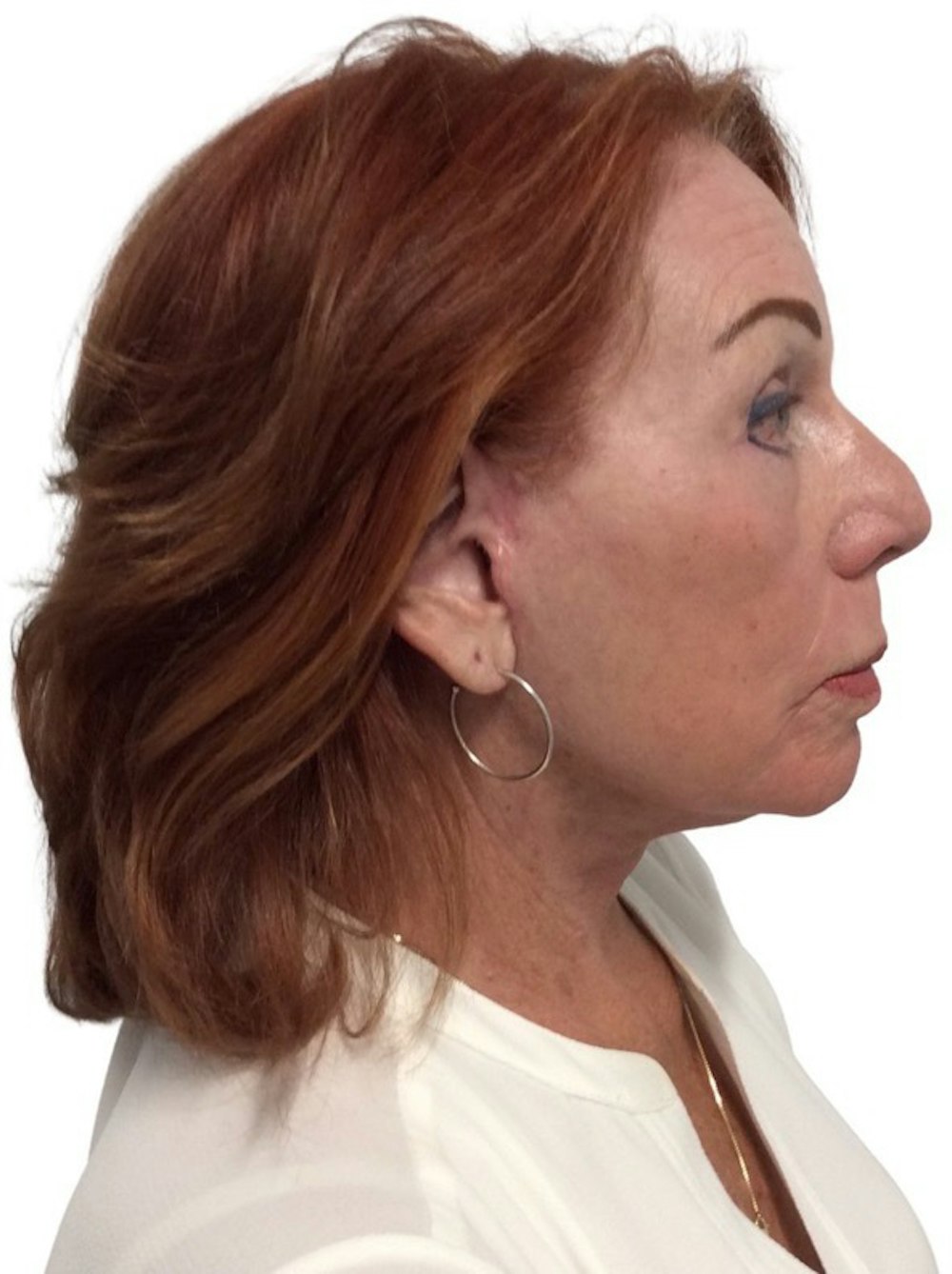 Deep Plane Facelift Before & After Gallery - Patient 13948537 - Image 8