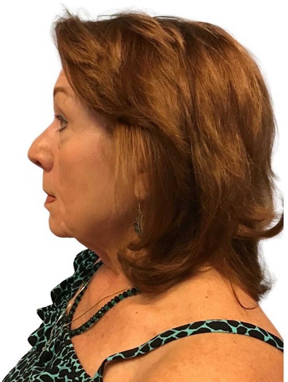 Deep Plane Facelift Before & After Gallery - Patient 13948537 - Image 9