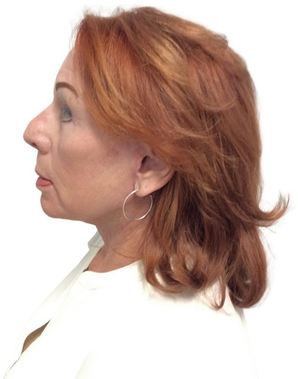 Deep Plane Facelift Before & After Gallery - Patient 13948537 - Image 10