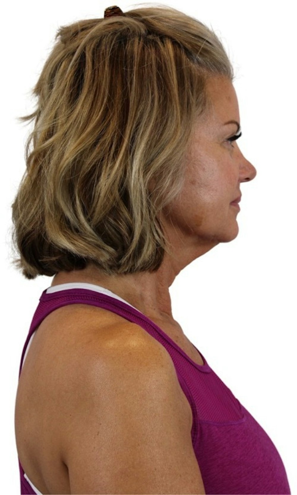 Deep Plane Facelift Before & After Gallery - Patient 13948539 - Image 7