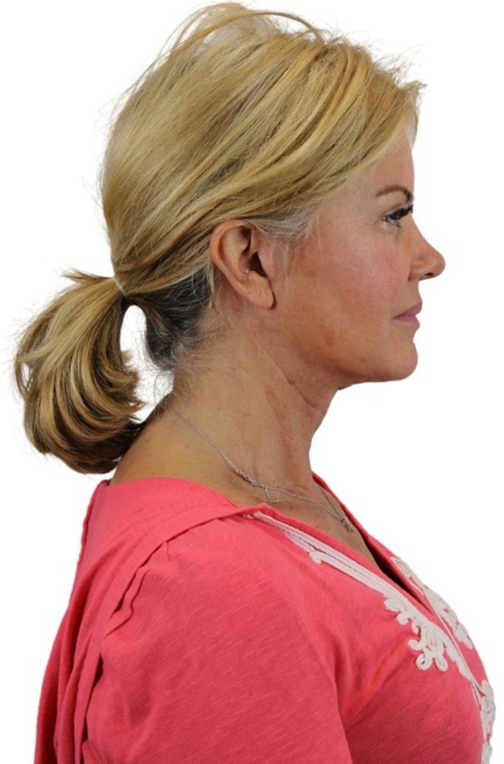 Deep Plane Facelift Before & After Gallery - Patient 13948539 - Image 8