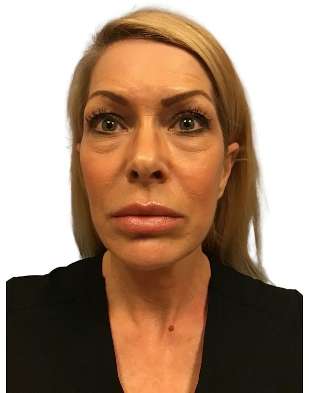 Deep Plane Facelift Before & After Gallery - Patient 13948540 - Image 1