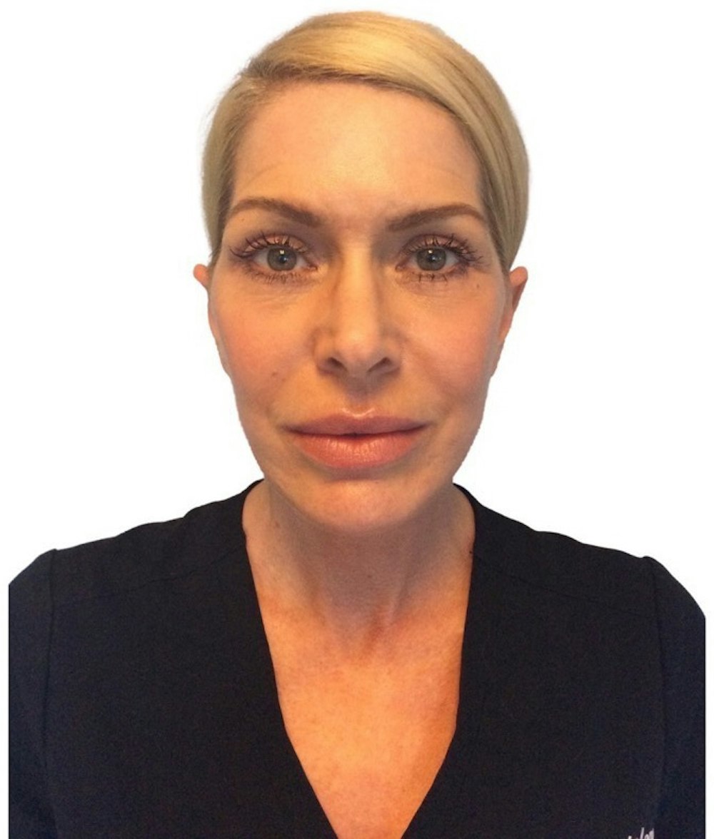 Deep Plane Facelift Before & After Gallery - Patient 13948540 - Image 2