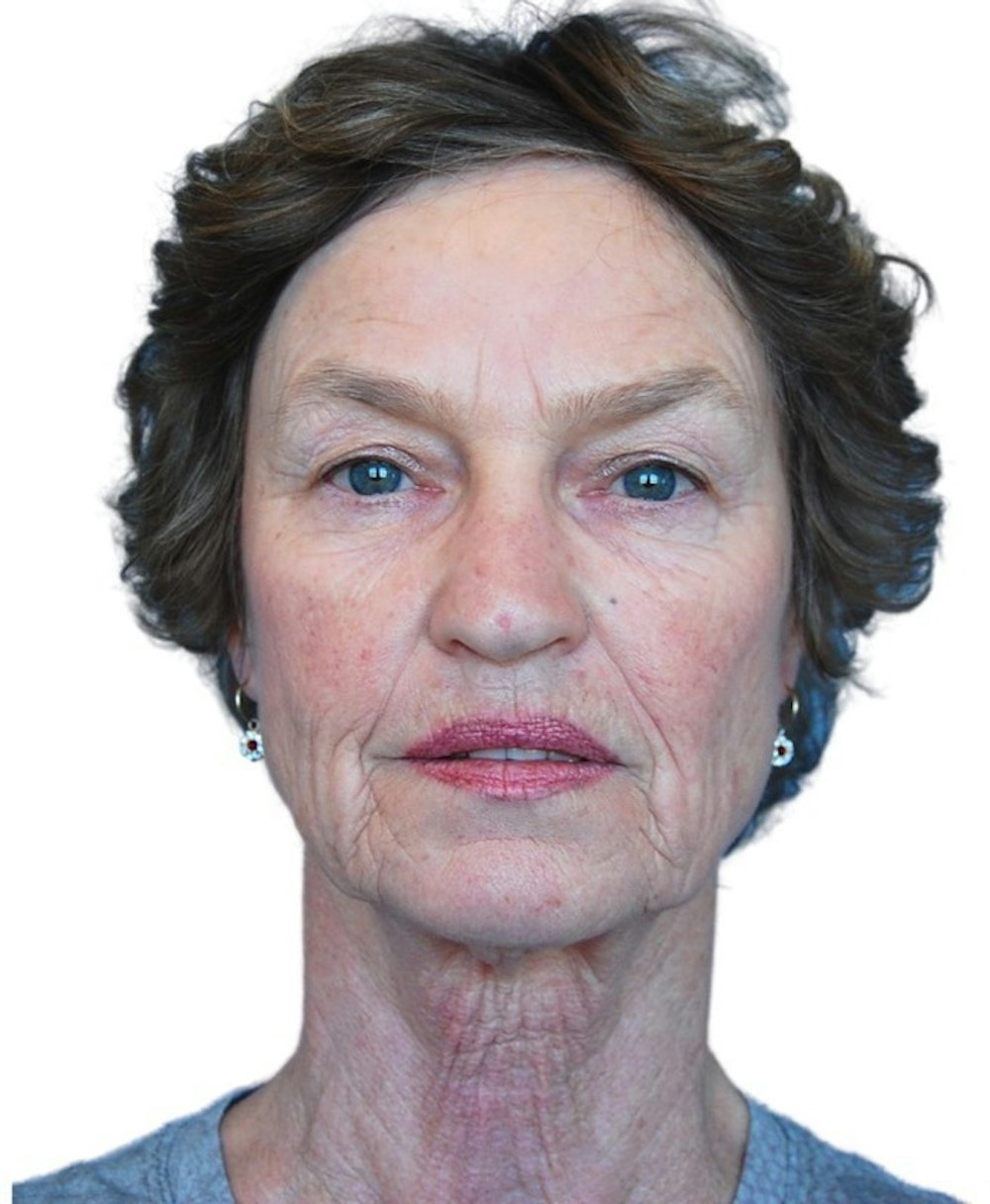 Deep Plane Facelift Before & After Gallery - Patient 13948541 - Image 1