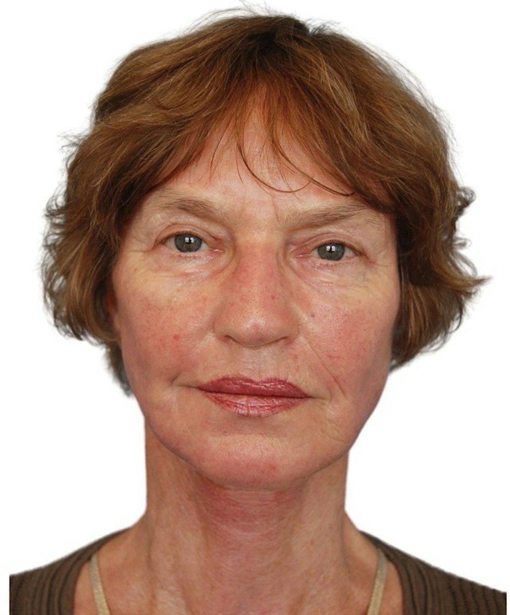 Deep Plane Facelift Before & After Gallery - Patient 13948541 - Image 2
