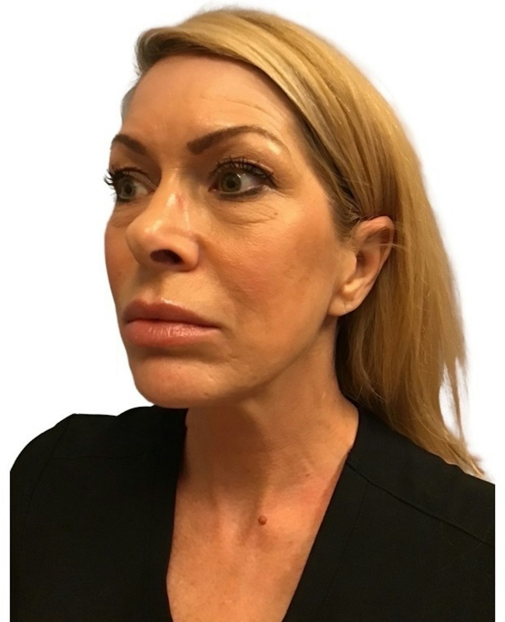 Deep Plane Facelift Before & After Gallery - Patient 13948540 - Image 3