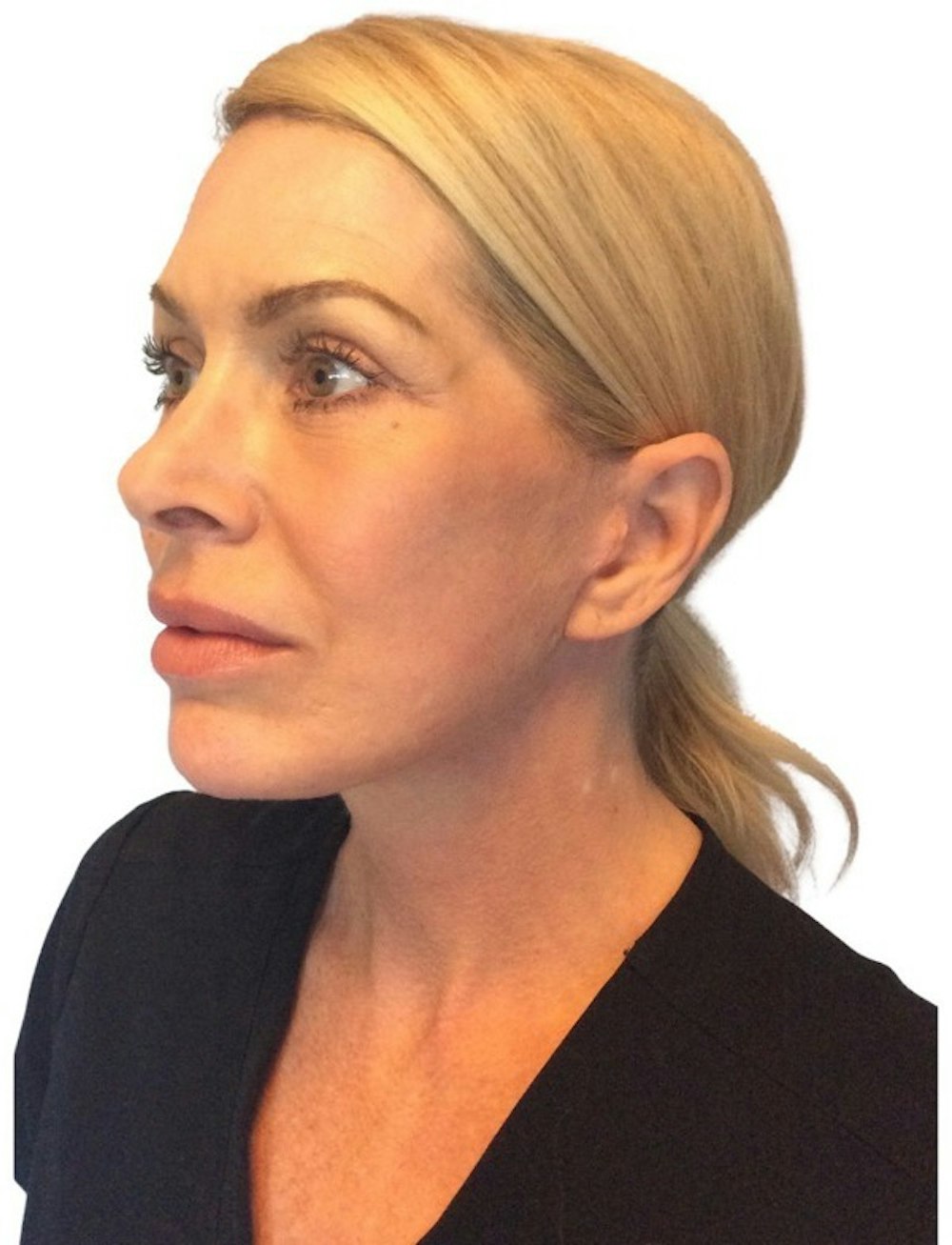 Deep Plane Facelift Before & After Gallery - Patient 13948540 - Image 4