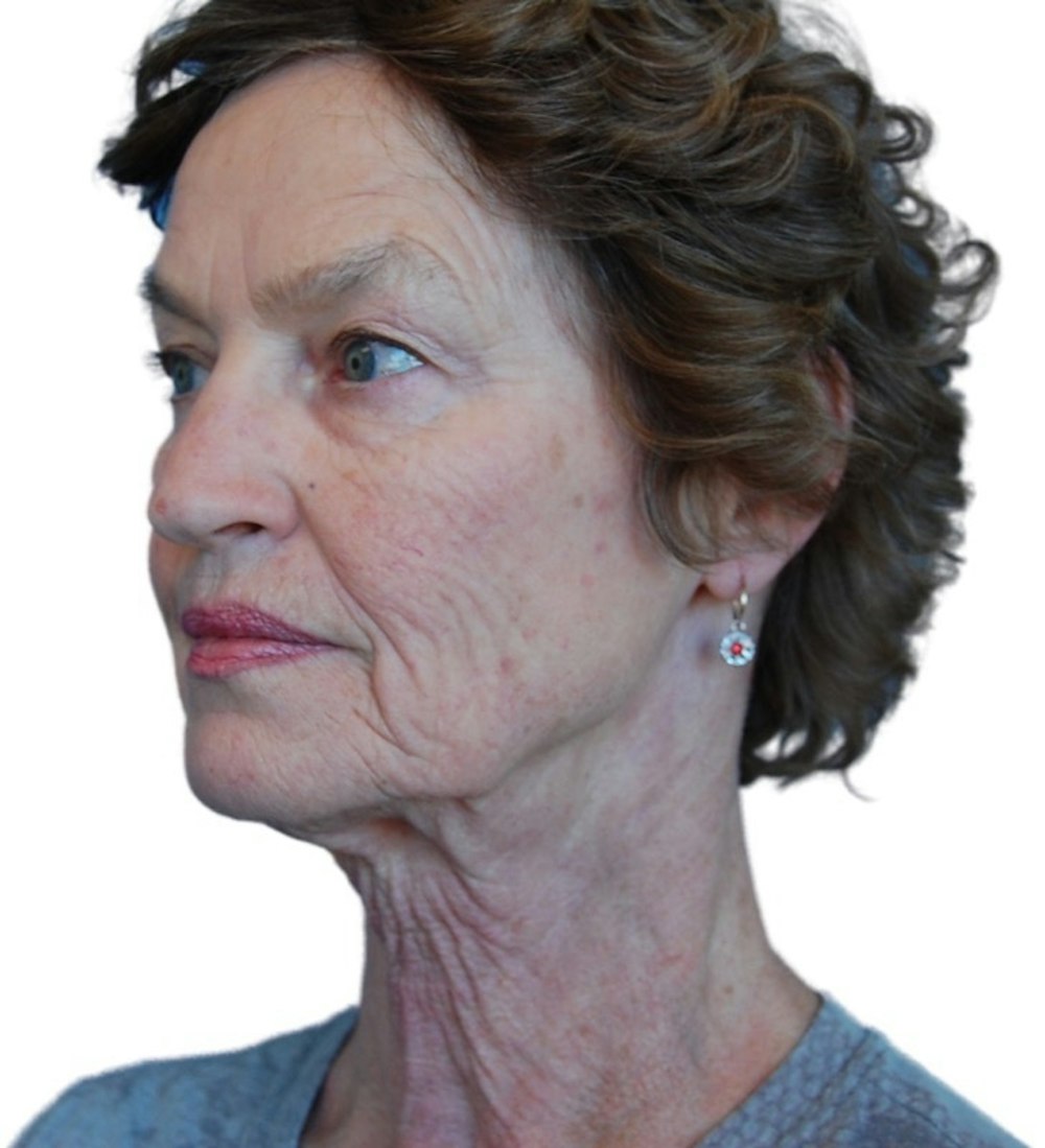 Facelift Before & After Gallery - Patient 13948541 - Image 3