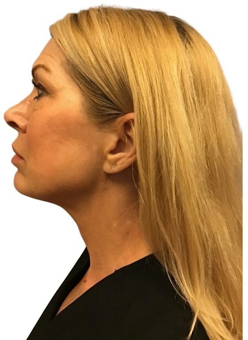 Deep Plane Facelift Before & After Gallery - Patient 13948540 - Image 5