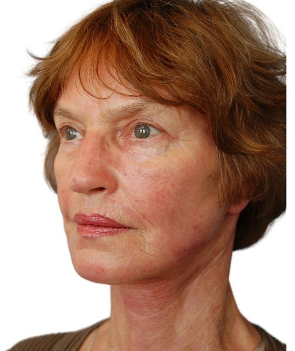 Deep Plane Facelift Before & After Gallery - Patient 13948541 - Image 4