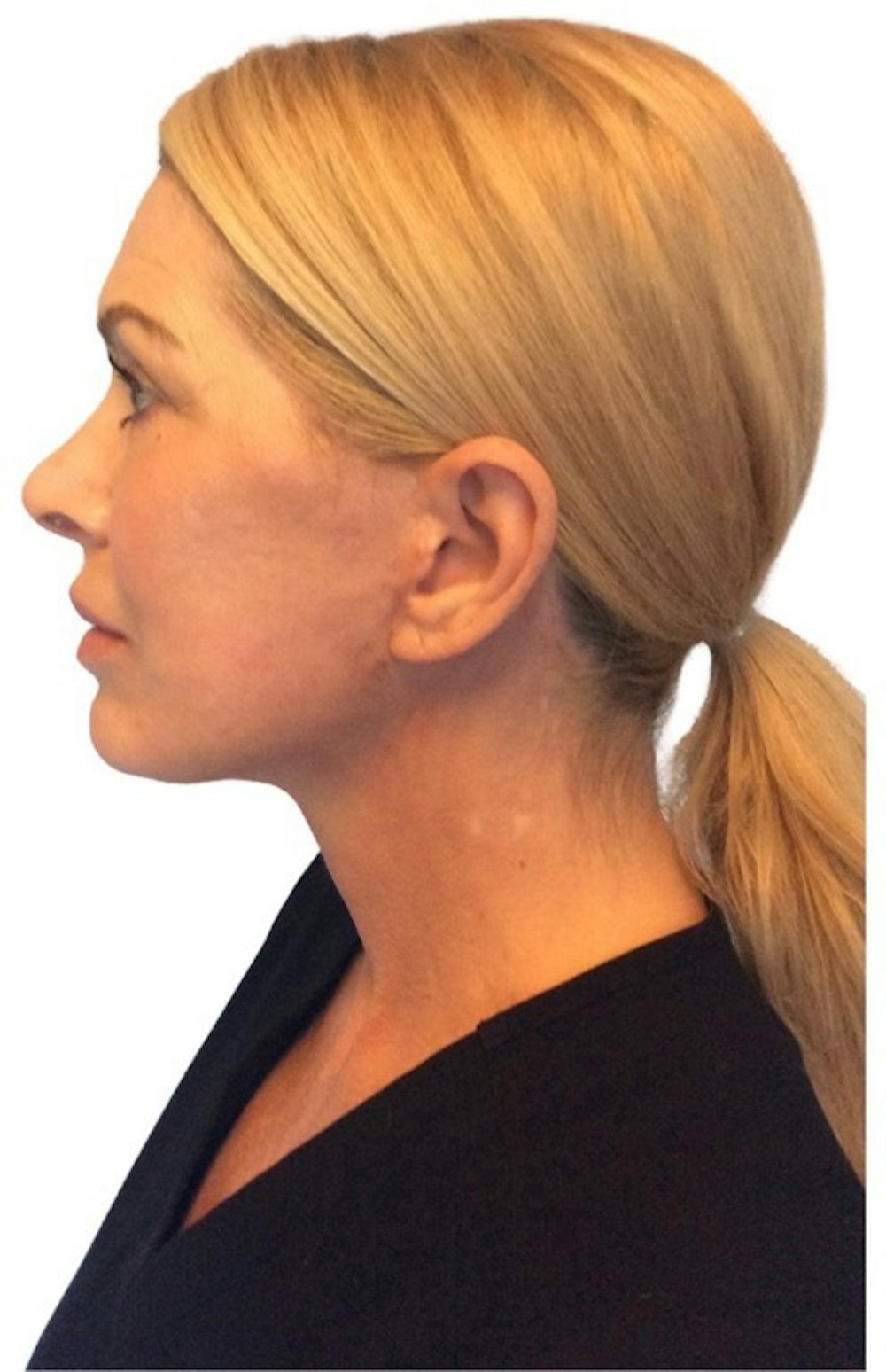 Deep Plane Facelift Before & After Gallery - Patient 13948540 - Image 6