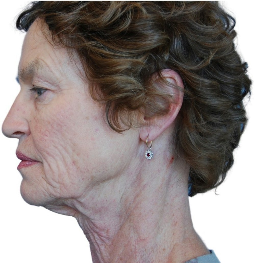 Facelift Before & After Gallery - Patient 13948541 - Image 5