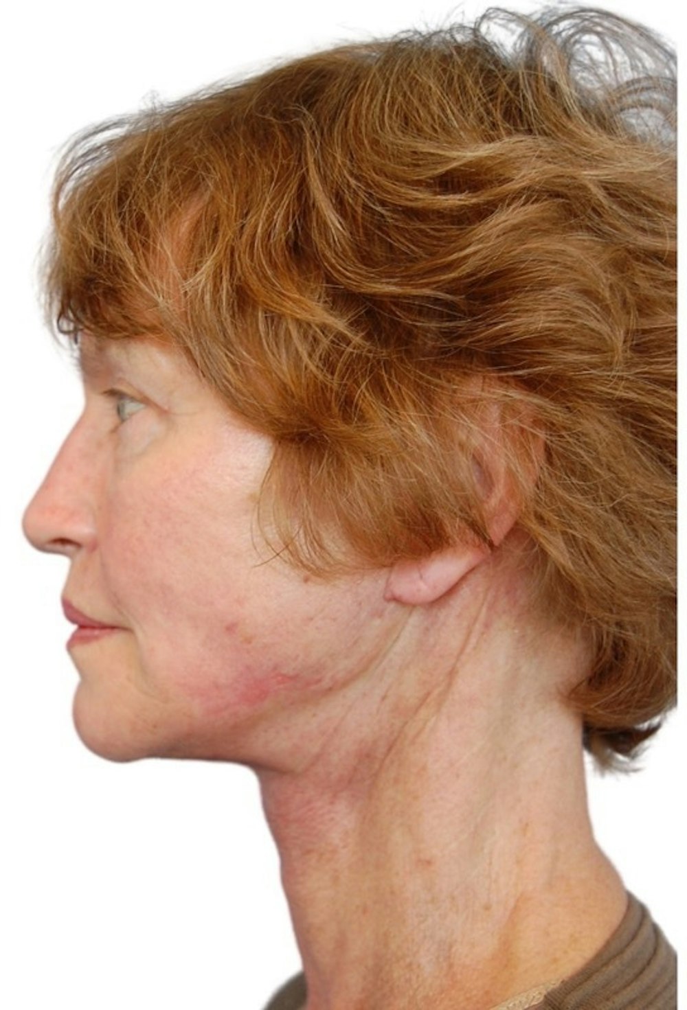 Facelift Before & After Gallery - Patient 13948541 - Image 6