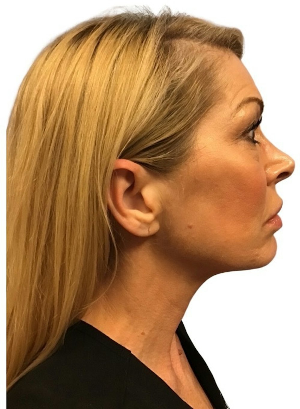 Deep Plane Facelift Before & After Gallery - Patient 13948540 - Image 7