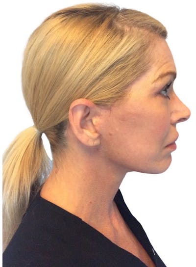 Deep Plane Facelift Before & After Gallery - Patient 13948540 - Image 8
