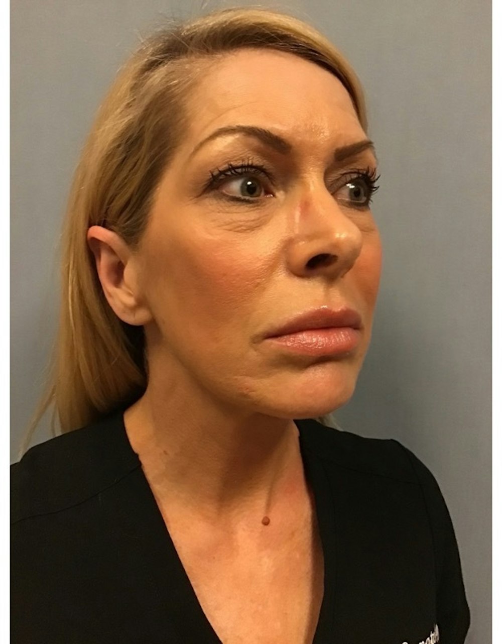 Deep Plane Facelift Before & After Gallery - Patient 13948540 - Image 9