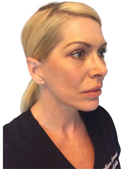 Deep Plane Facelift Before & After Gallery - Patient 13948540 - Image 10