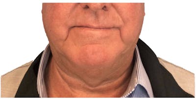 Deep Neck Lift Before & After Gallery - Patient 13948542 - Image 1