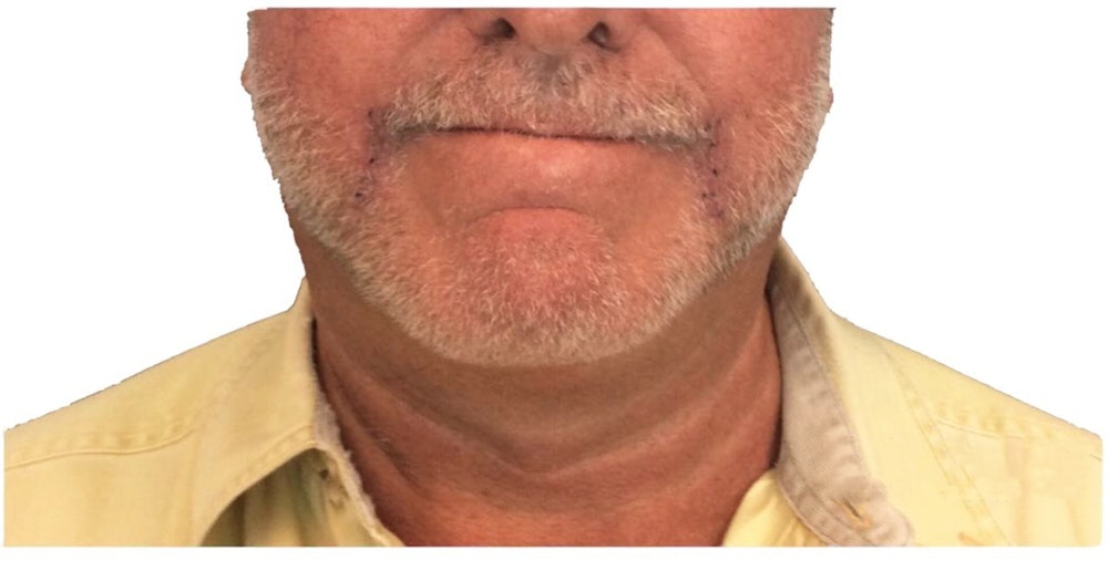 Deep Neck Lift Before & After Gallery - Patient 13948542 - Image 2