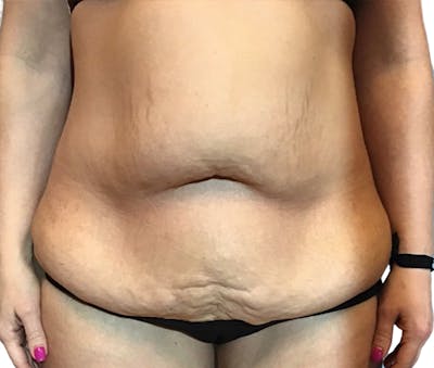 Abdominoplasty Before & After Gallery - Patient 16688827 - Image 1
