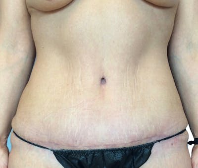 Abdominoplasty Before & After Gallery - Patient 16688827 - Image 2