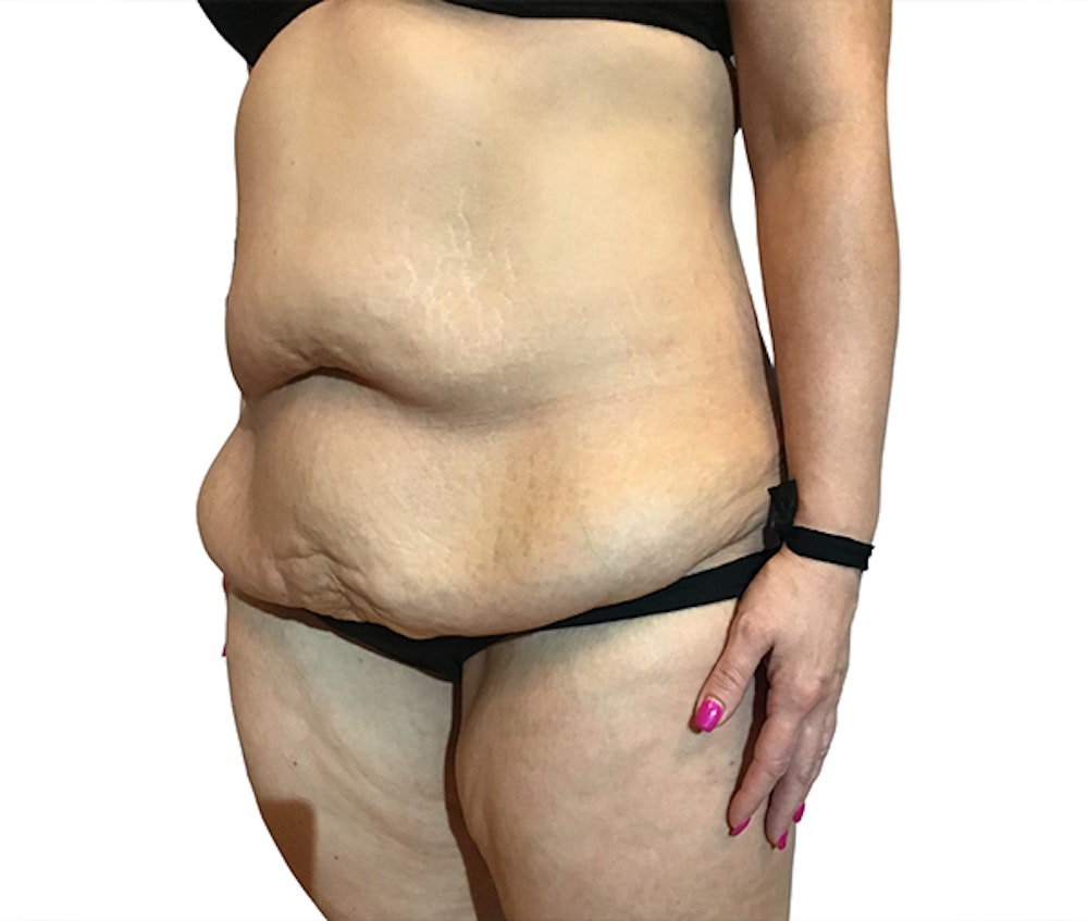 Abdominoplasty Before & After Gallery - Patient 16688827 - Image 3