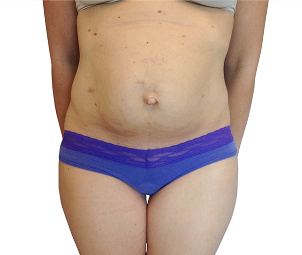 Abdominoplasty Before & After Gallery - Patient 18427947 - Image 1