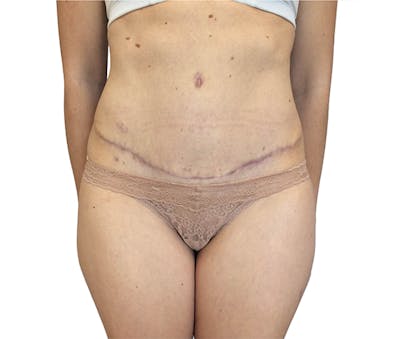 Abdominoplasty Before & After Gallery - Patient 18427947 - Image 2