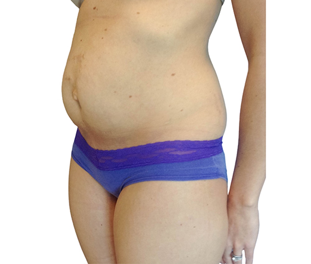 Abdominoplasty Before & After Gallery - Patient 18427947 - Image 3