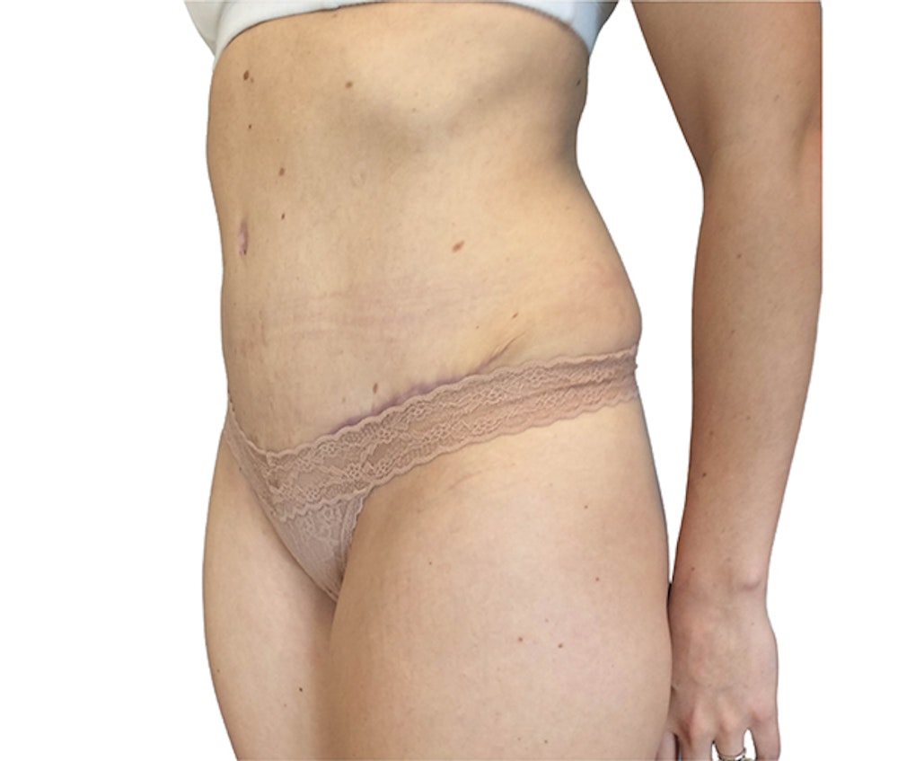 Abdominoplasty Before & After Gallery - Patient 18427947 - Image 4