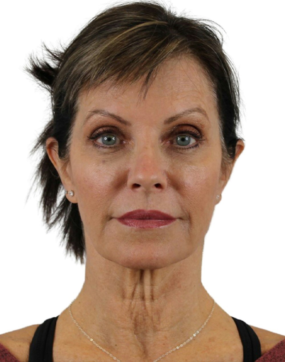Deep Plane Facelift Before & After Gallery - Patient 24397141 - Image 1