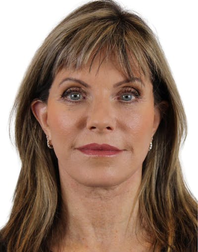 Deep Plane Facelift Before & After Gallery - Patient 24397141 - Image 2