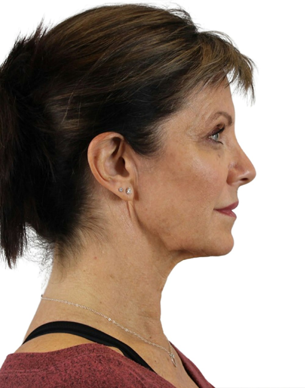 Deep Plane Facelift Before & After Gallery - Patient 24397141 - Image 5
