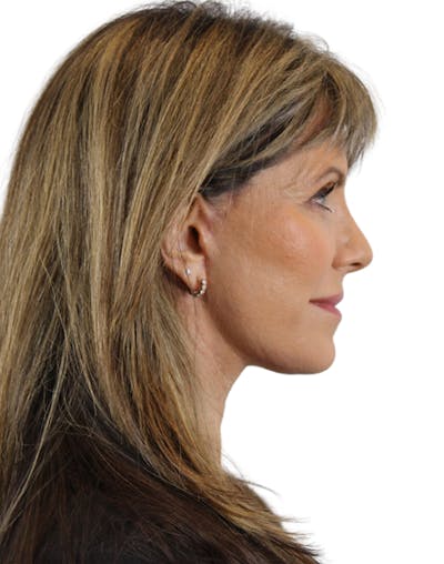 Deep Plane Facelift Before & After Gallery - Patient 24397141 - Image 6