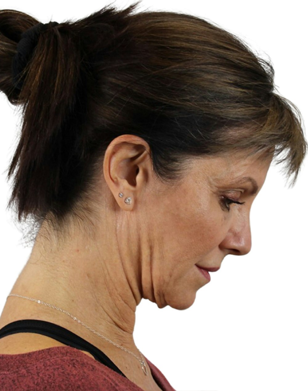 Deep Plane Facelift Before & After Gallery - Patient 24397141 - Image 7
