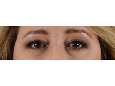 Blepharoplasty Before & After Gallery - Patient 37534883 - Image 1