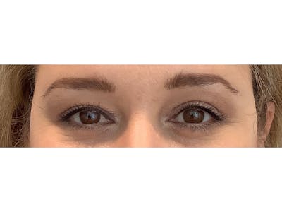 Blepharoplasty Before & After Gallery - Patient 37534883 - Image 2