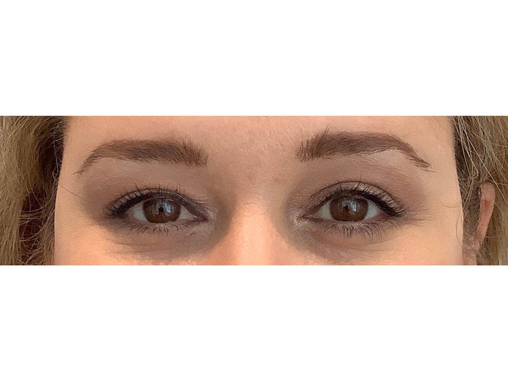 Blepharoplasty Before & After Gallery - Patient 37534883 - Image 2