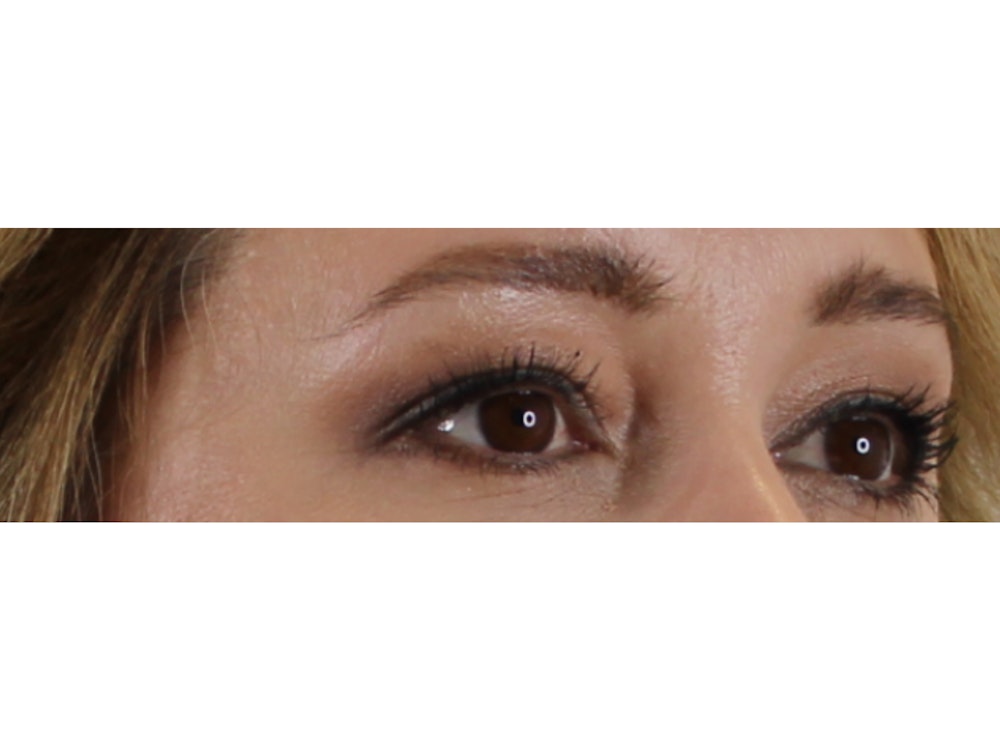 Blepharoplasty Before & After Gallery - Patient 37534883 - Image 3