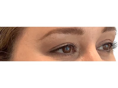 Blepharoplasty Before & After Gallery - Patient 37534883 - Image 4