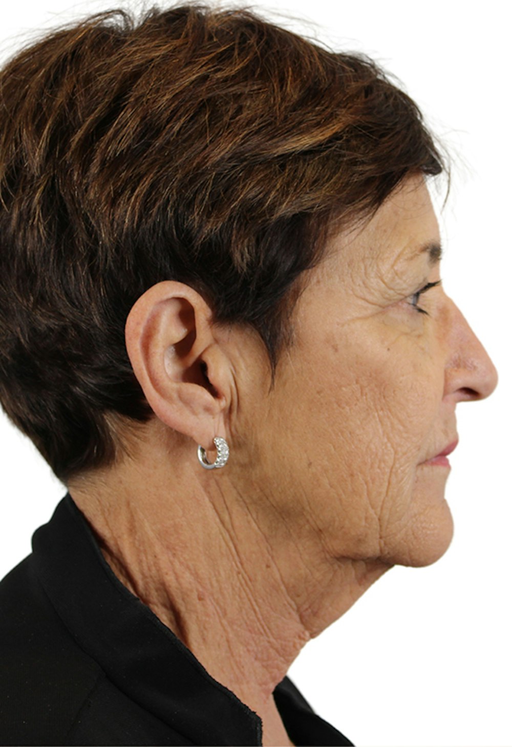 Deep Plane Facelift Before & After Gallery - Patient 37535053 - Image 3