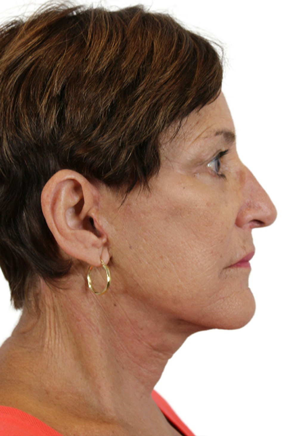 Facelift Before & After Gallery - Patient 37535053 - Image 4