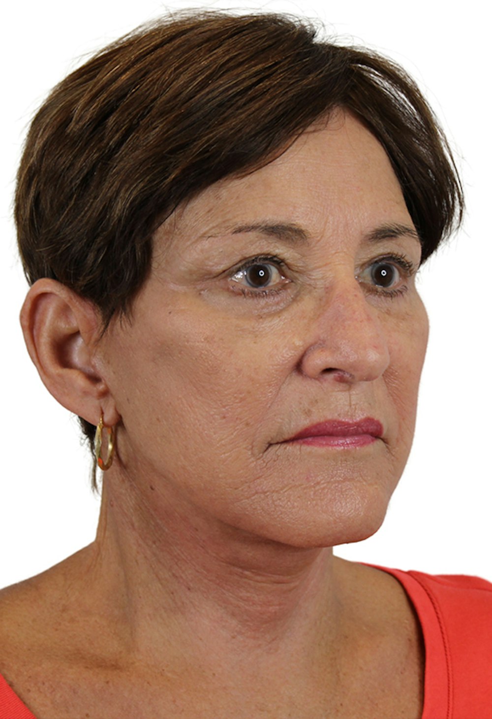 Facelift Before & After Gallery - Patient 37535053 - Image 6