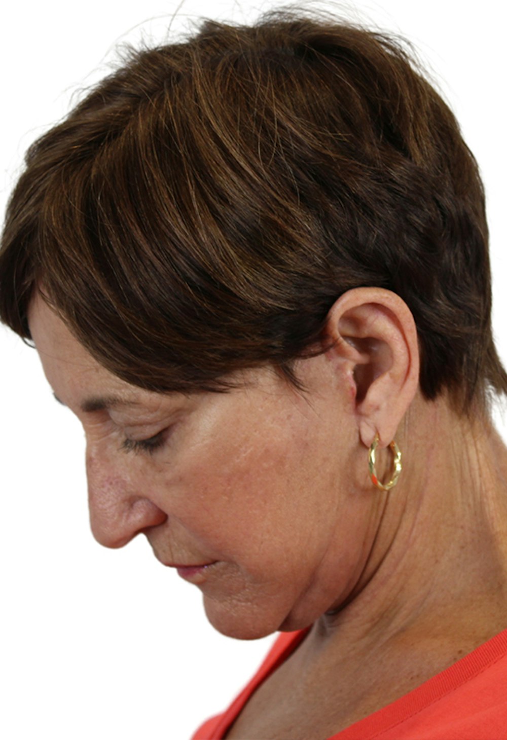 Deep Plane Facelift Before & After Gallery - Patient 37535053 - Image 8