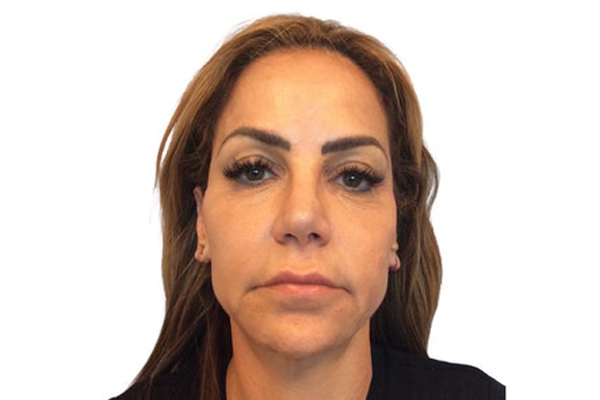 Facelift - Before/After Before
